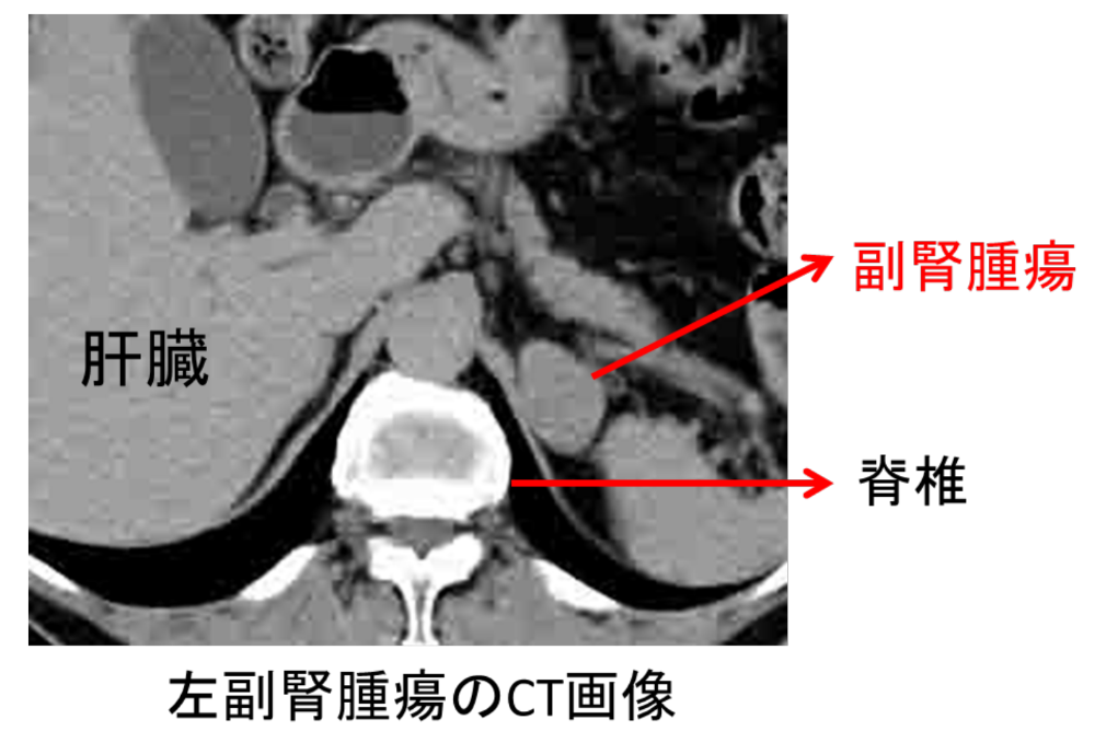 左副腎腫瘍のCT画像
