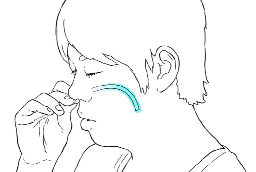 ナステント図1