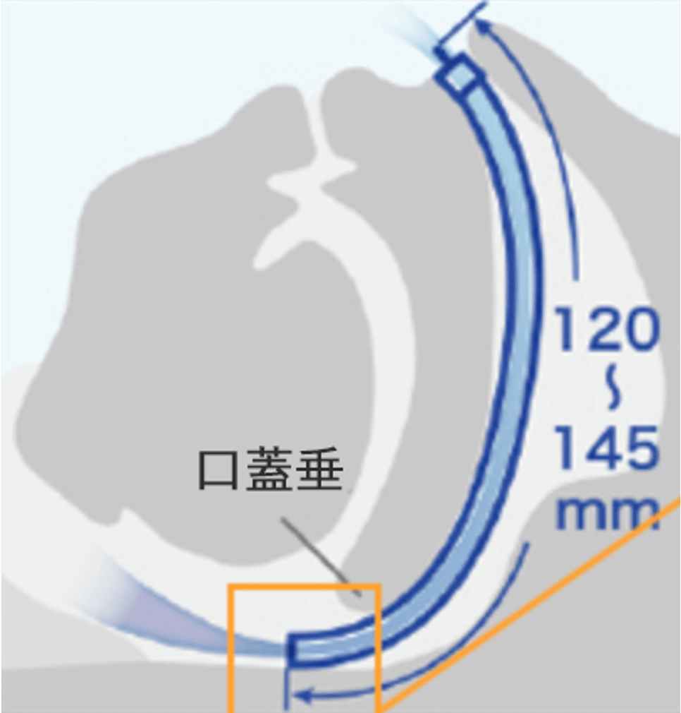 ナステント図2
