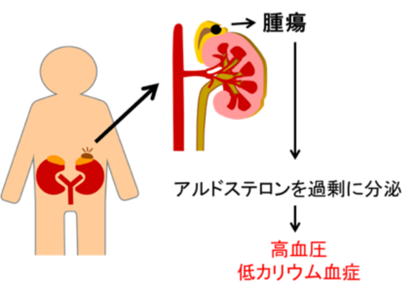 高アルドステロン症と低アルドステロン症の診断
