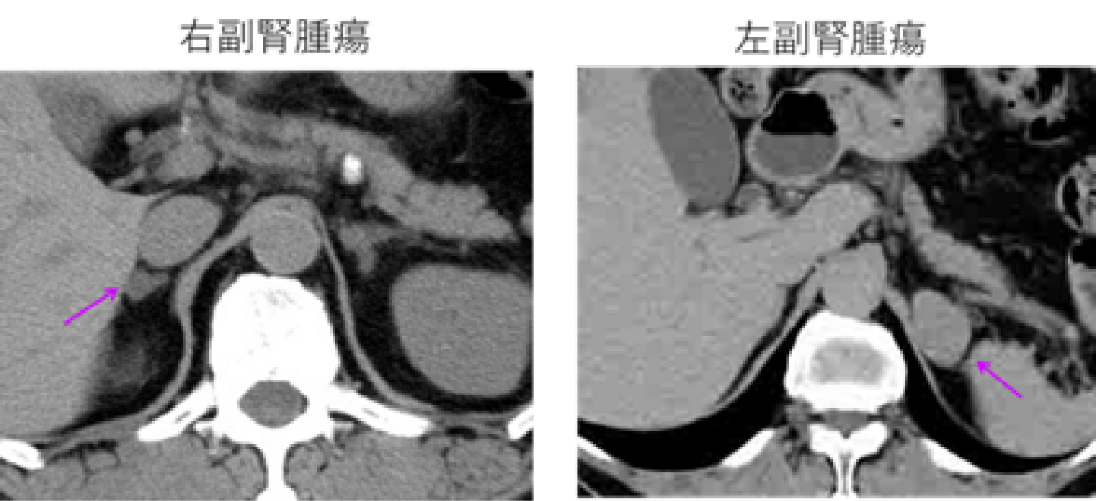 CT は副腎腫瘍を検出するのに最適な画像処理ですか?