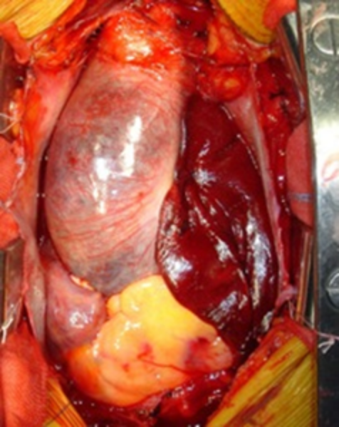 腹部大動脈瘤