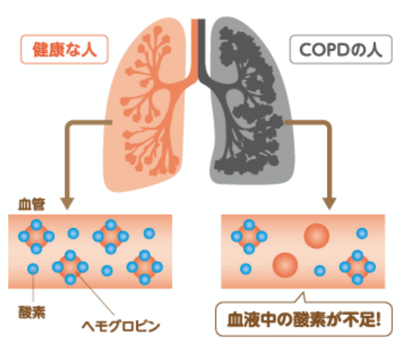 COPDでは低酸素血症を起こす