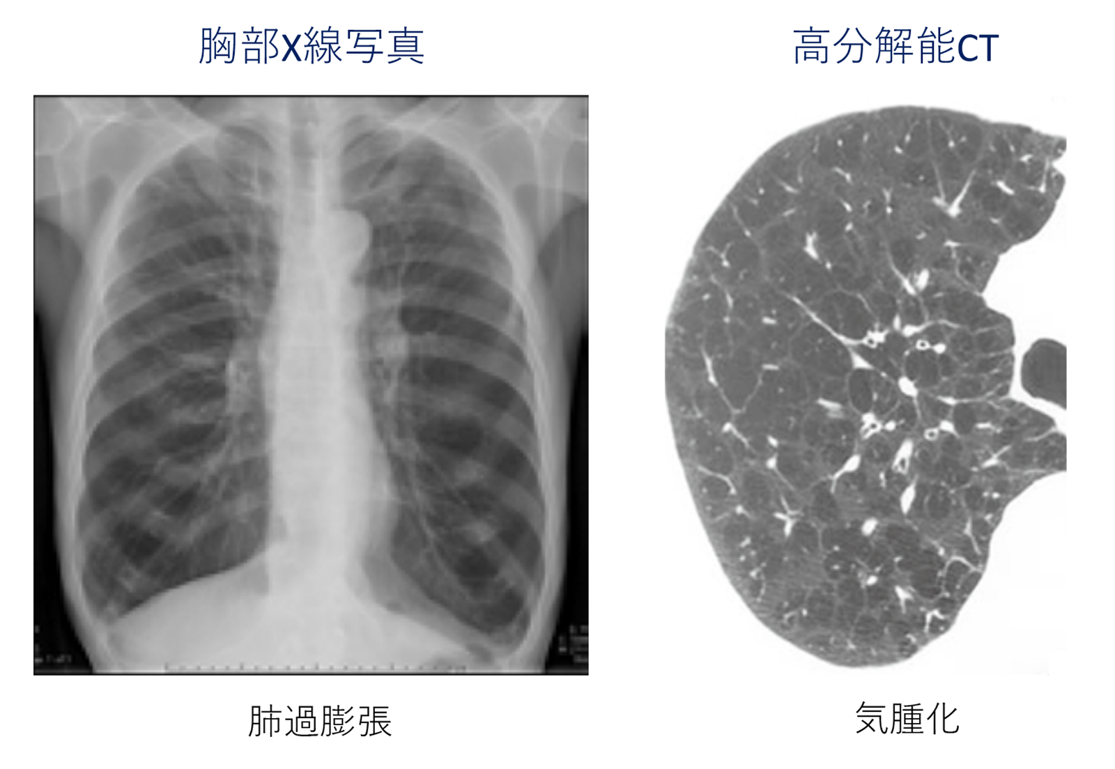 COPDの胸部X線画像と高分解能CT画像
